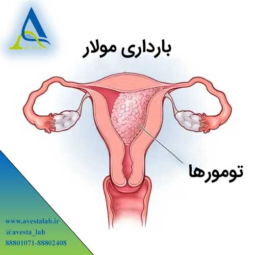 بارداری مولار