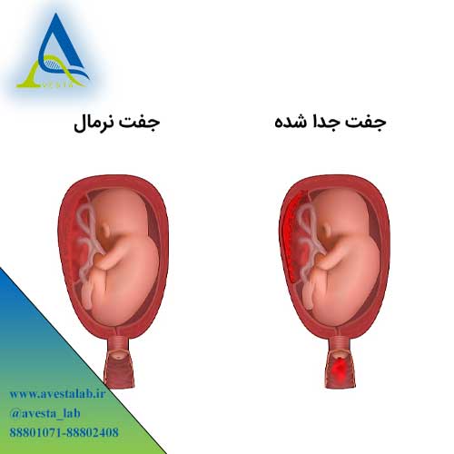 جداشدگی جفت