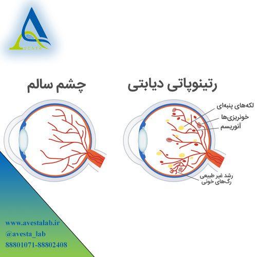 رتینوپاتی مرتبط با دیابت