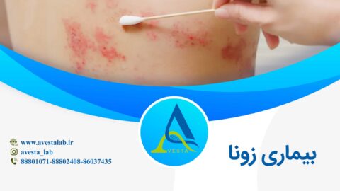 بیماری زونا