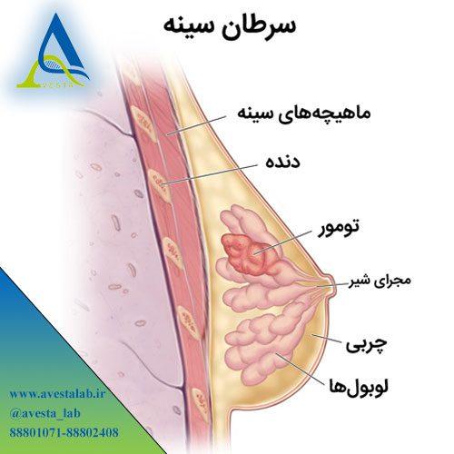 سرطان سینه