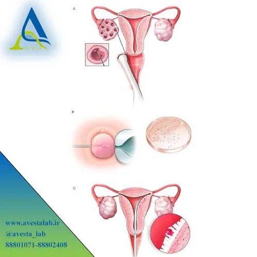 لقاح آزمایشگاهی IVF