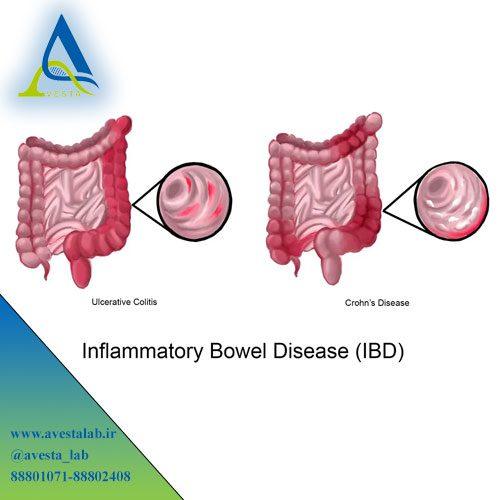 بیماری التهابی روده (IBD)