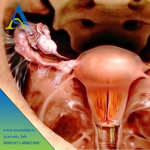 بیماری التهابی لگن PID