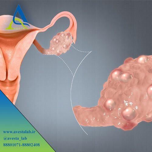 سندرم تخمدان پلی کیستیک PCOS