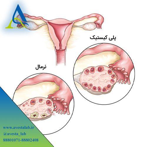 سندرم تخمدان پلی کیستیک PCOS