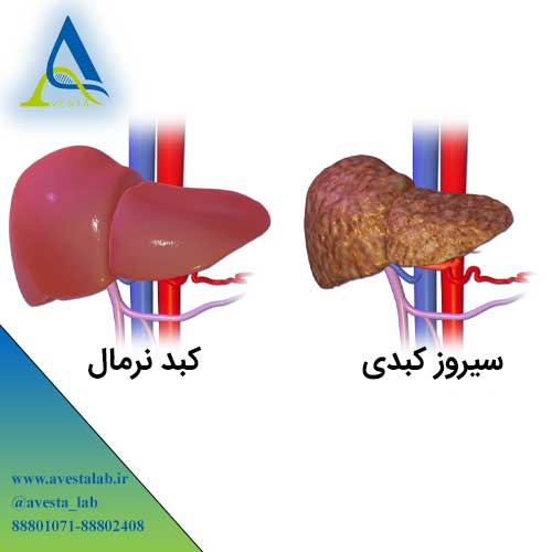 سیروز کبدی
