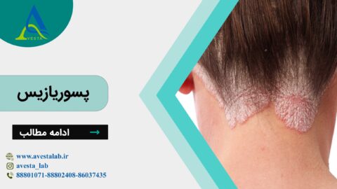 پسوریازیس