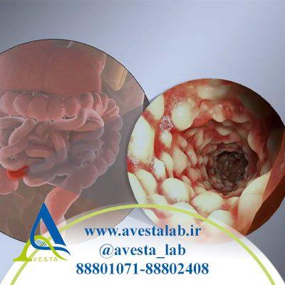 بیماری کرون