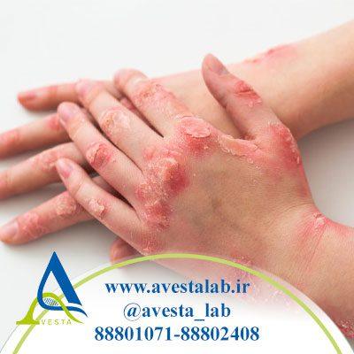 بیماری پروانه ای