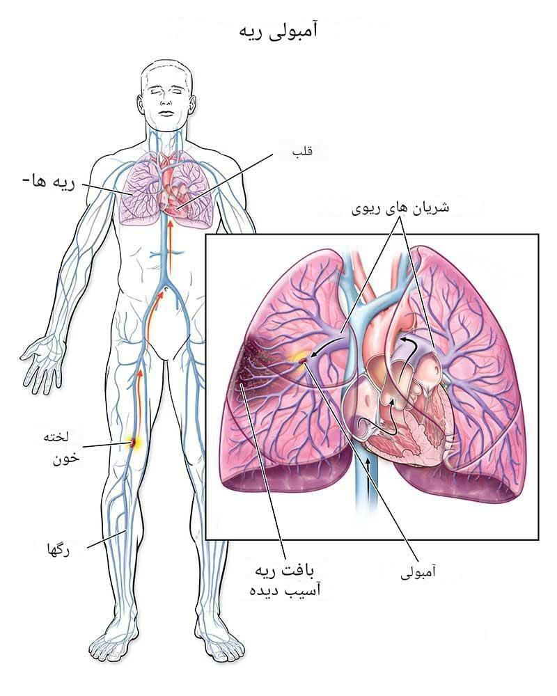 آمبولی ریه (PE)