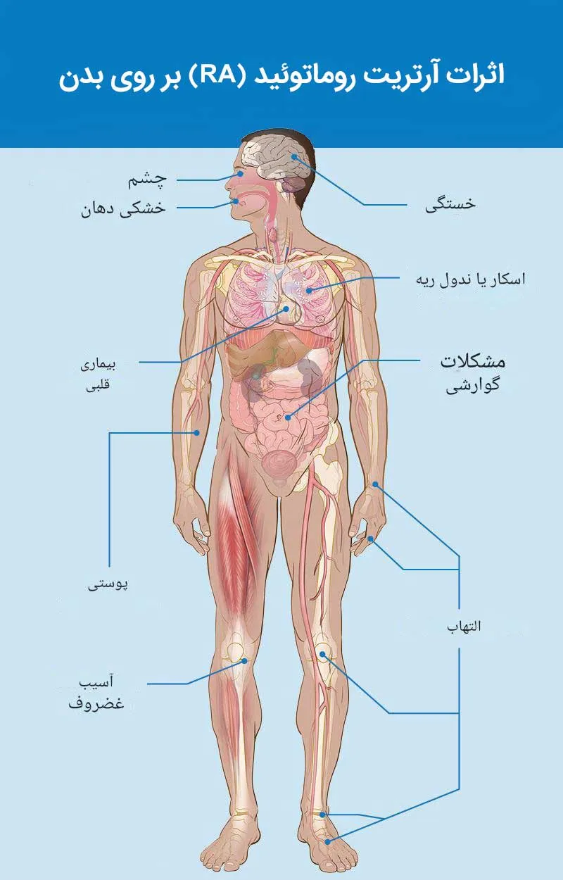 آرتریت روماتوئید چیست؟