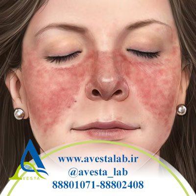 لوپوس چیست؟ علائم و درمان