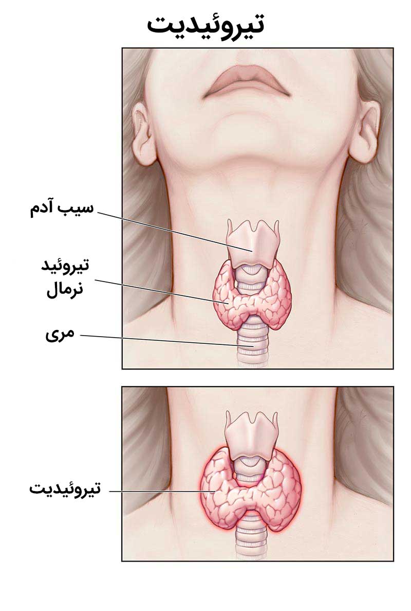 تیروئیدیت