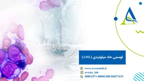 لوسمی حاد میلوئیدی (AML)