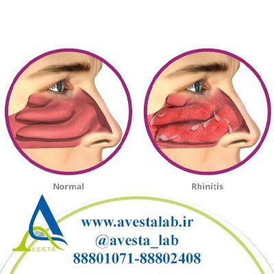 رینیت آلرژیک (تب یونجه)