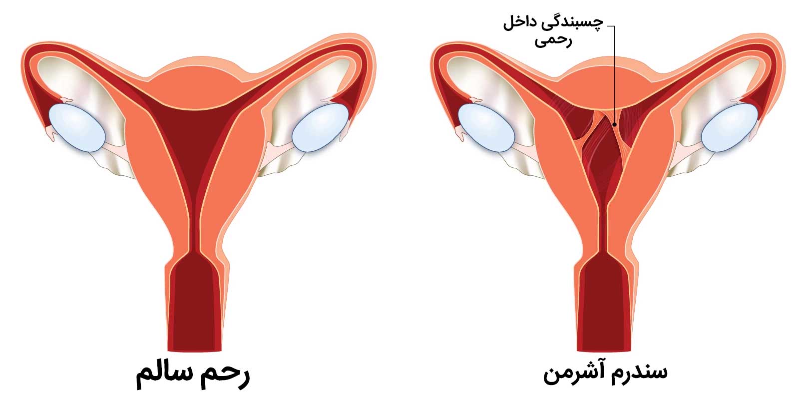 سندرم آشرمن چیست؟