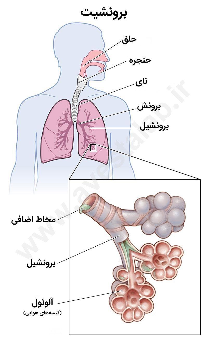 برونشیت چیست؟