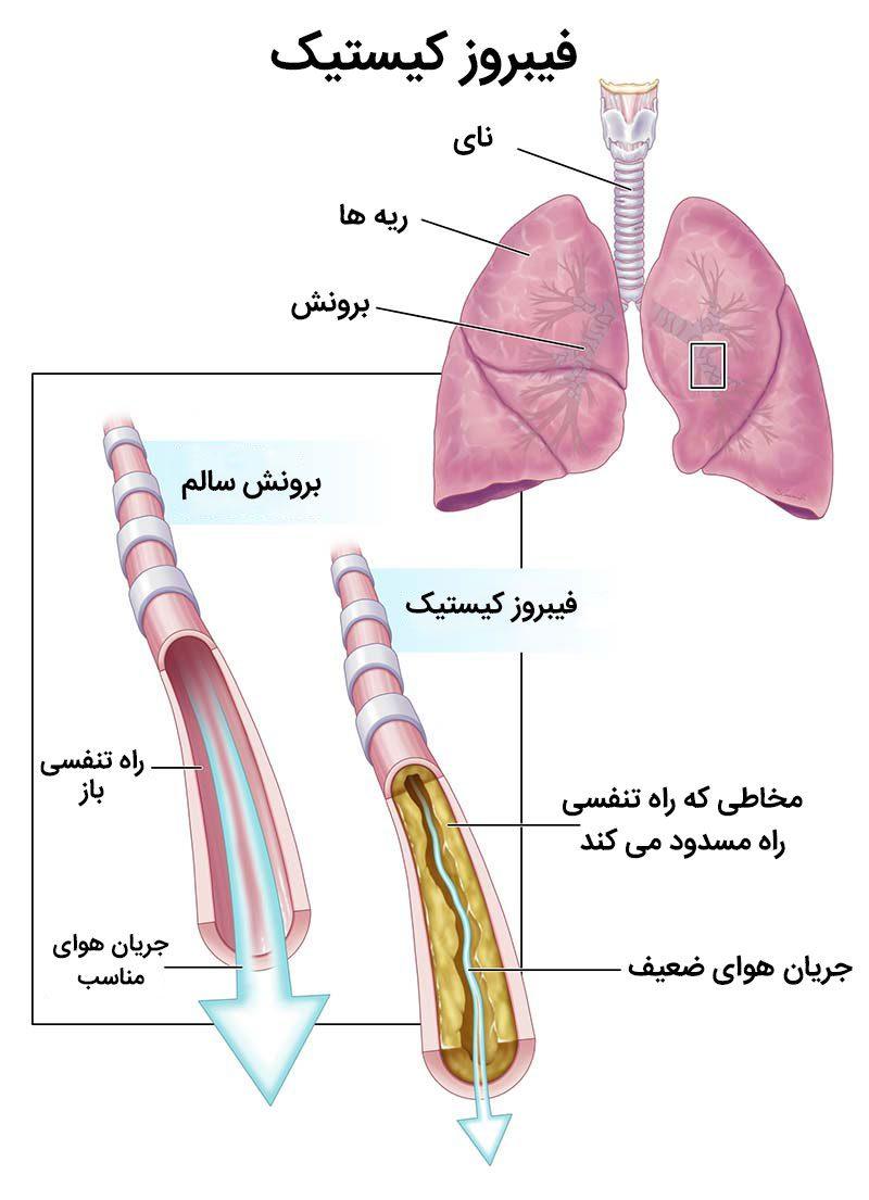 فیبروز کیستیک (CF)