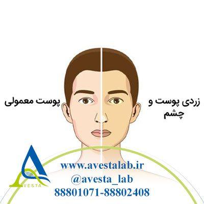سندرم ژیلبرت