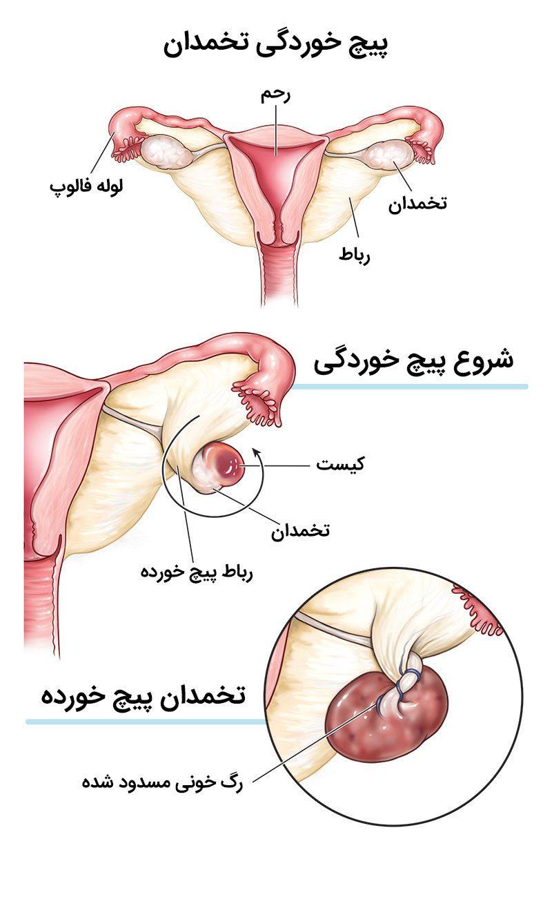 پیچ خوردگی تخمدان