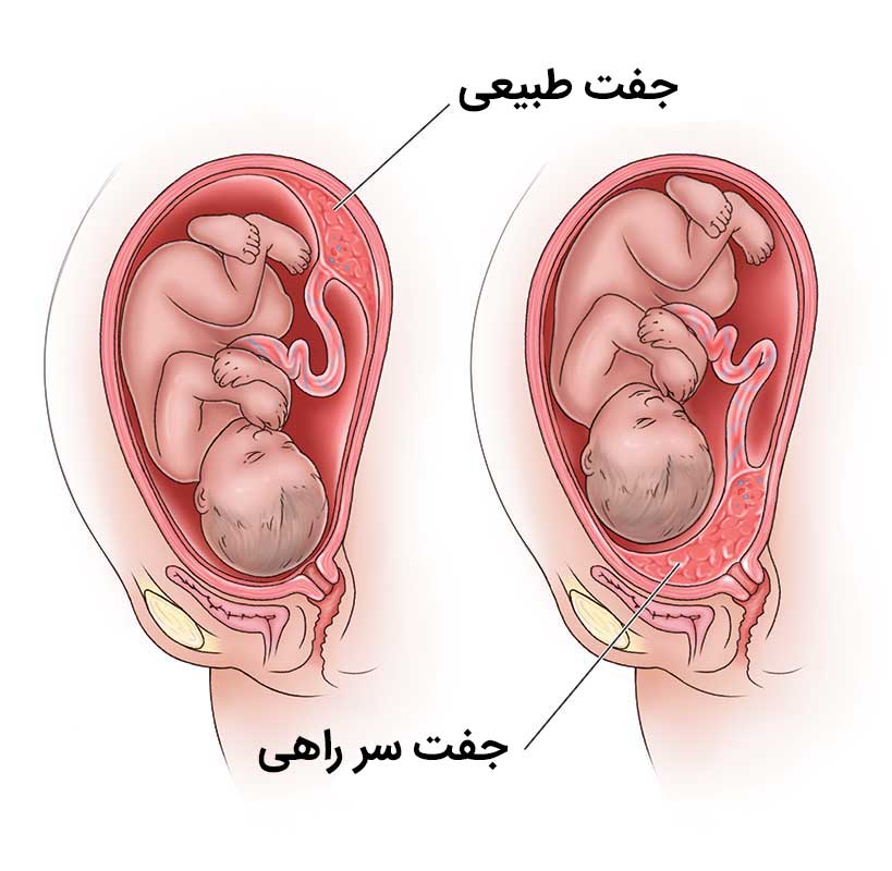 جفت سر راهی