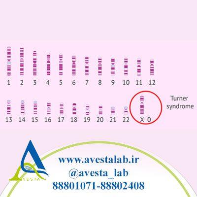 سندرم ترنر