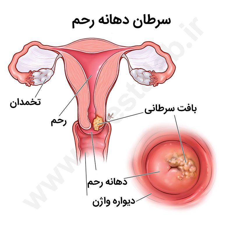 سرطان دهانه رحم