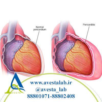 پریکاردیت