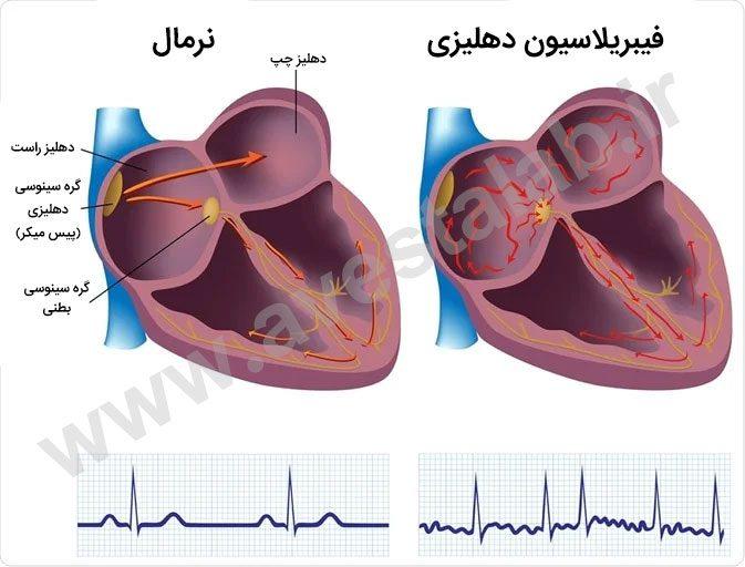 فیبریلاسیون دهلیزی