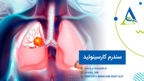 سندرم کارسینوئید