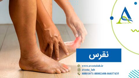 نقرس