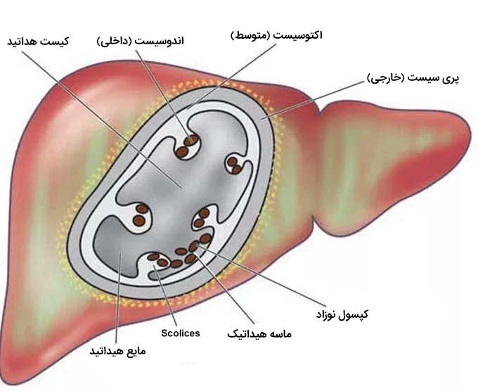 بیماری هیداتید