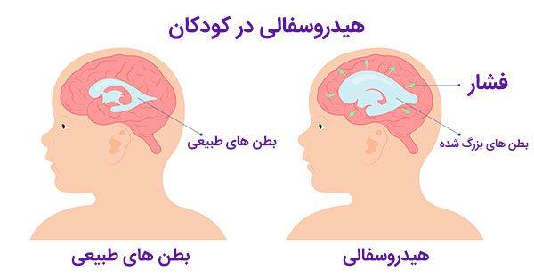 هیدروسفالی