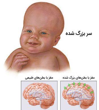 هیدروسفالی