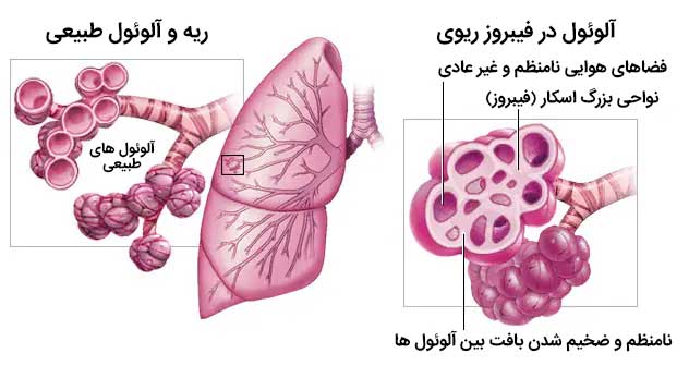فیبروز ریوی