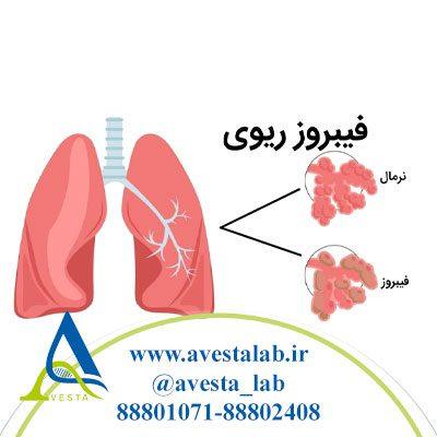 فیبروز ریوی