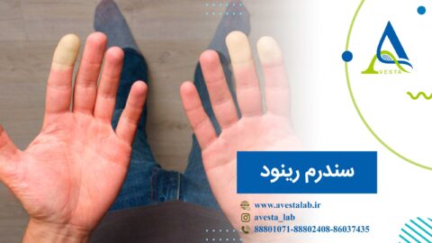 سندرم رینود