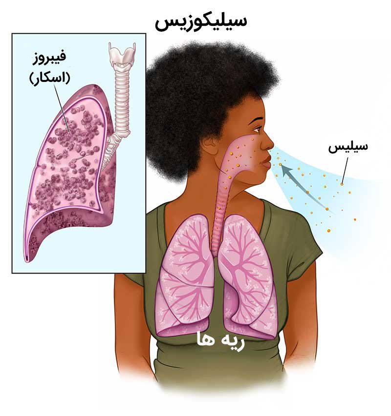 سیلیکوزیس