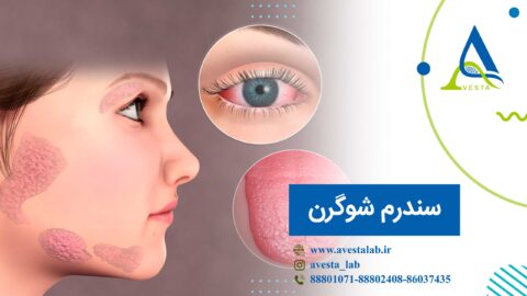 سندرم شوگرن