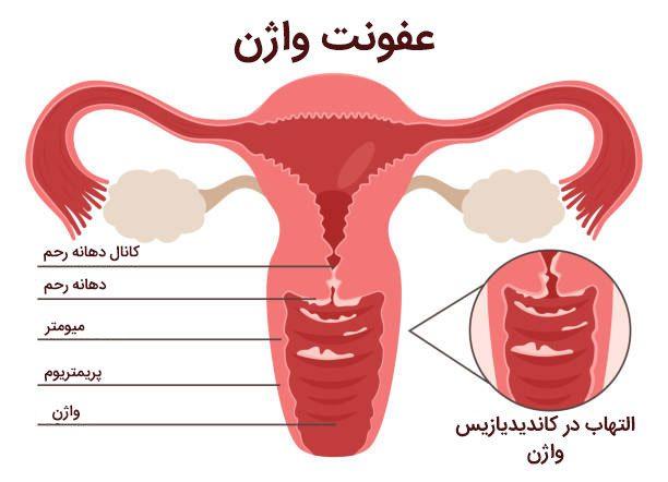 عفونت واژن