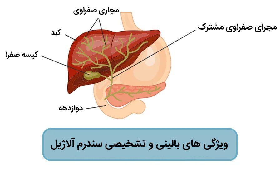 سندرم آلاژیل