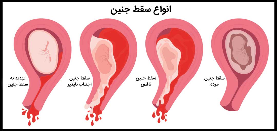 سقط جنین