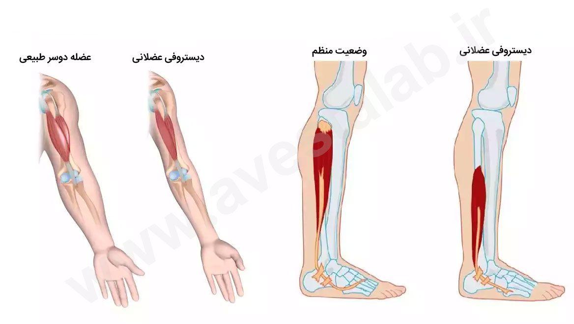 دیستروفی عضلانی