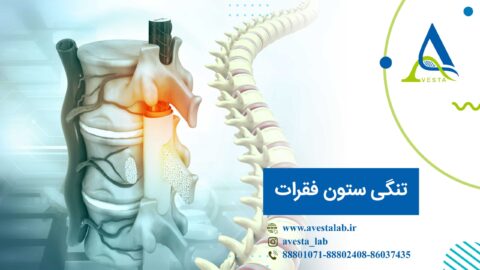 تنگی کانال نخاعی