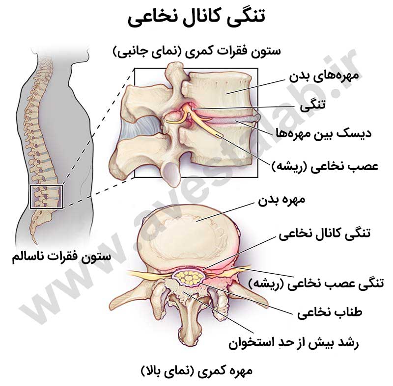 تنگی کانال نخاعی