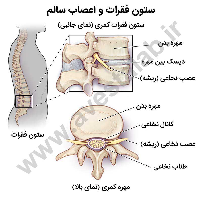 تنگی کانال نخاعی