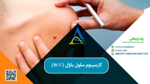 کارسینوم سلول بازال (BCC)