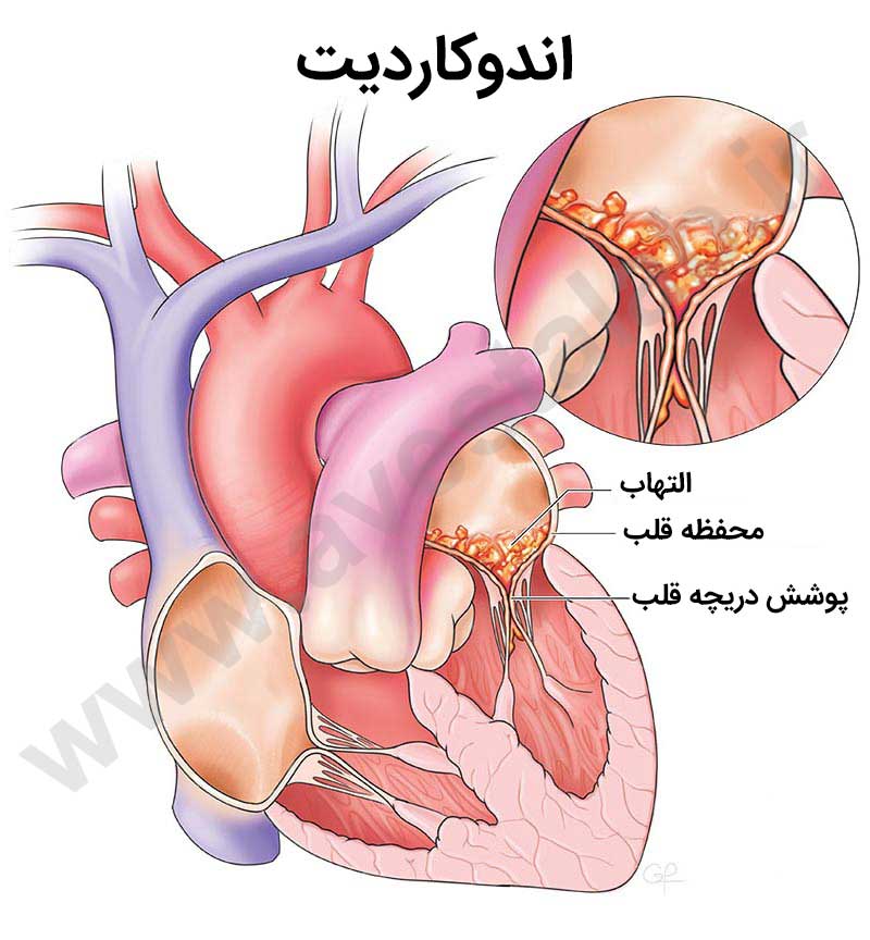 اندوکاردیت