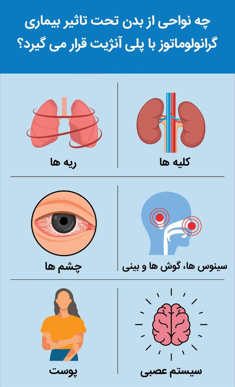 گرانولوماتوز با پلی آنژیت (GPA)
